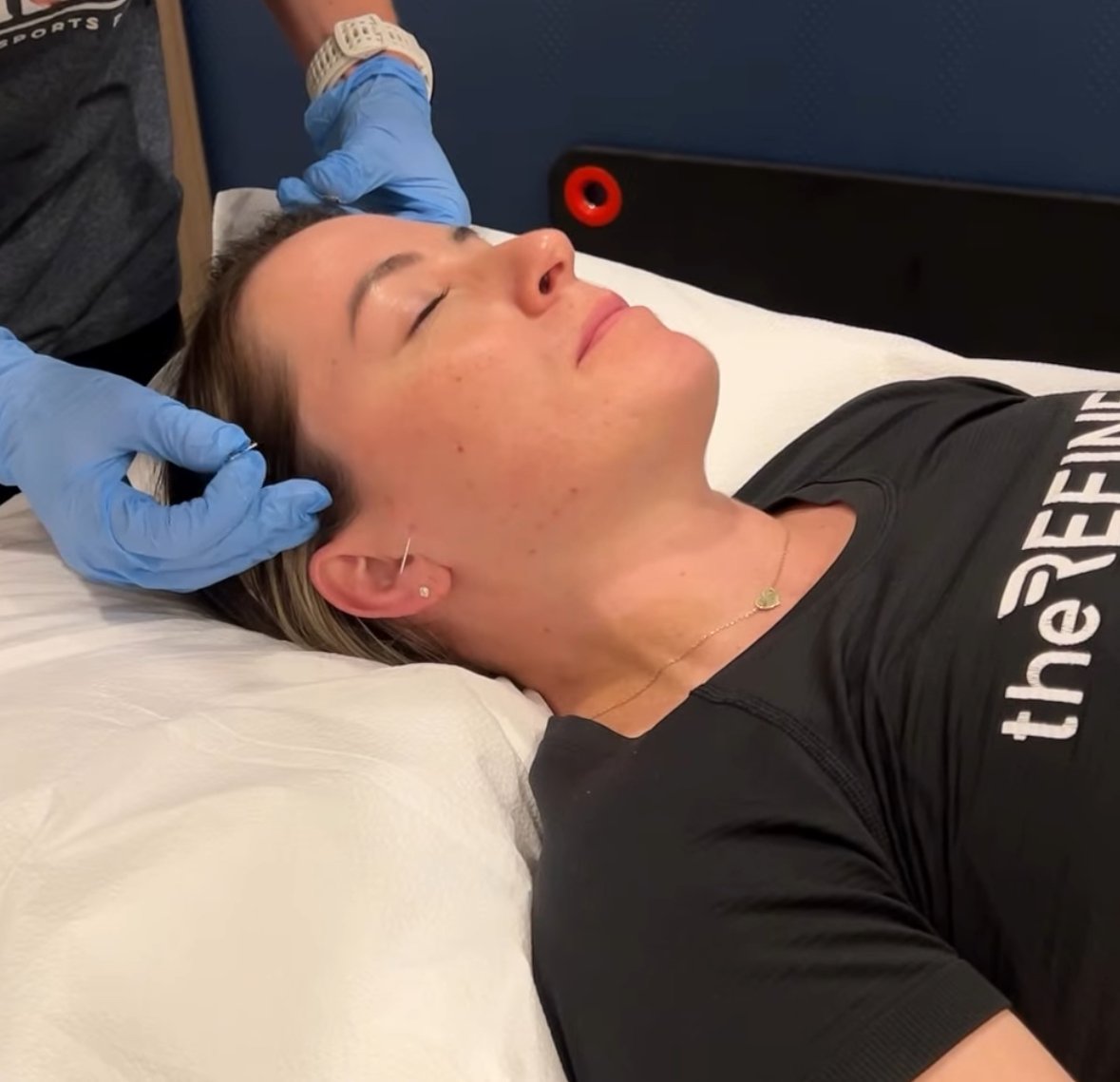 dry needling