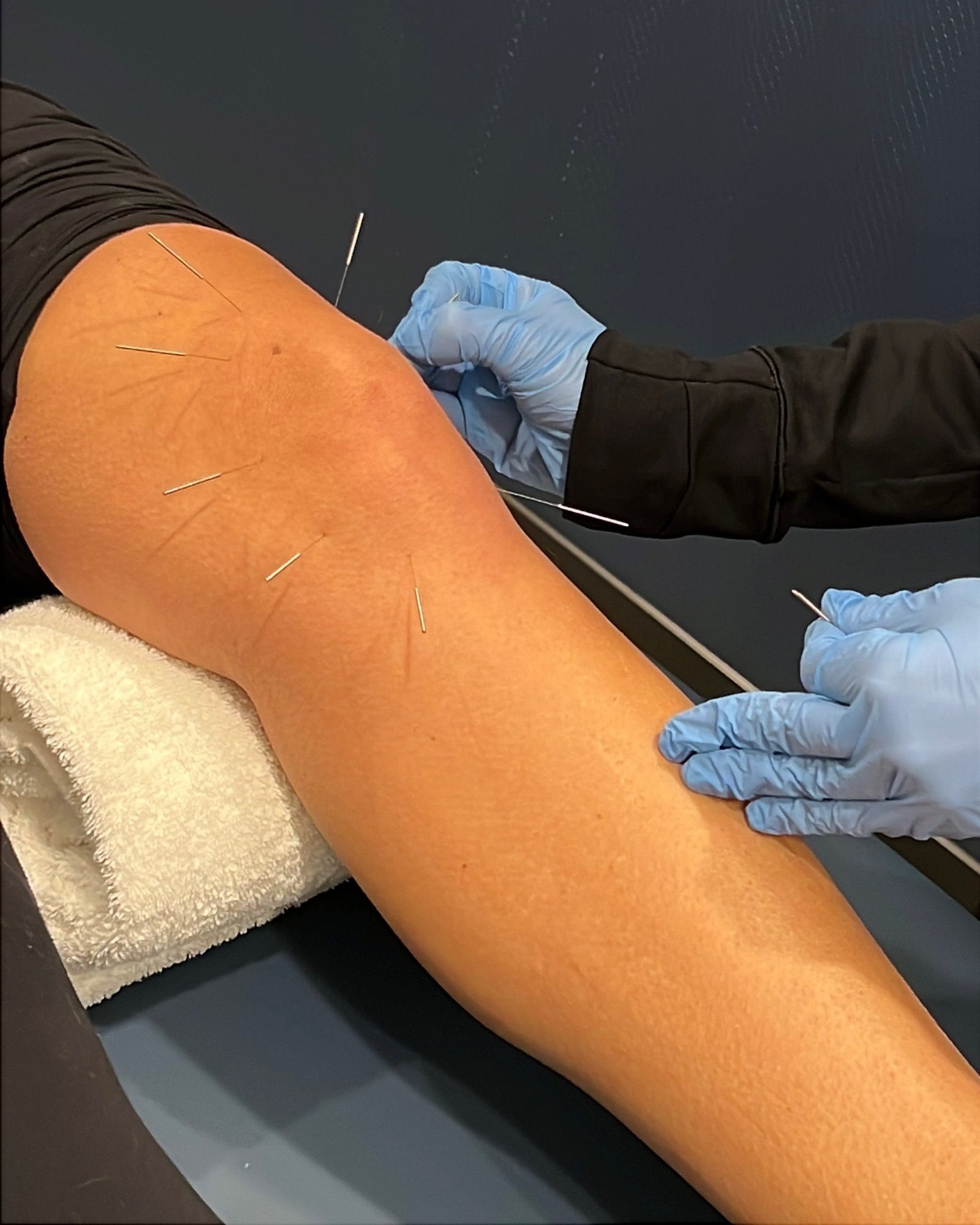 dry needling